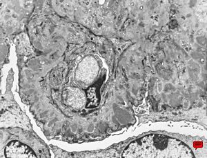 M,68y. | membranous glomerulopathy - late stage